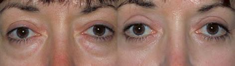 Blepharoplasty before and after photos in San Francisco, CA, Patient 12993