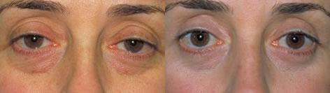 Blepharoplasty before and after photos in San Francisco, CA, Patient 12996