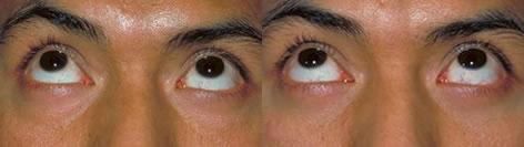 Blepharoplasty before and after photos in San Francisco, CA, Patient 12999