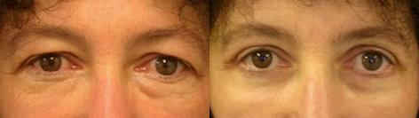 Blepharoplasty before and after photos in San Francisco, CA, Patient 13005