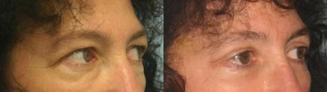 Blepharoplasty before and after photos in San Francisco, CA, Patient 13008