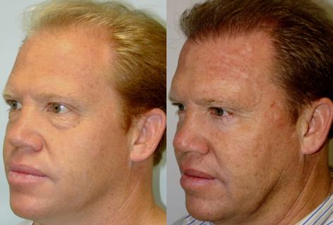 Blepharoplasty before and after photos in San Francisco, CA, Patient 13011