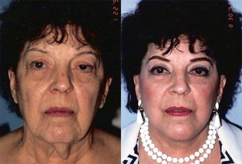 Blepharoplasty before and after photos in San Francisco, CA, Patient 13012