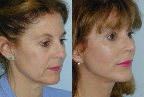 Blepharoplasty before and after photos in San Francisco, CA, Patient 13022