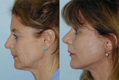 Blepharoplasty before and after photos in San Francisco, CA, Patient 13022