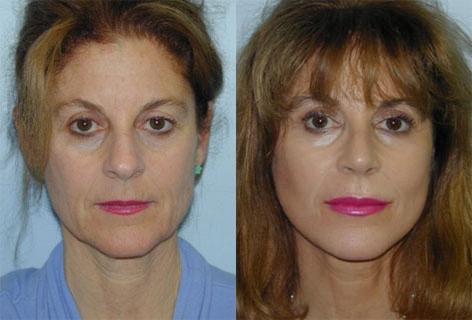 Blepharoplasty before and after photos in San Francisco, CA, Patient 13022