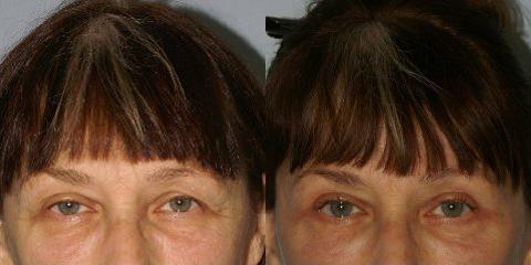 Blepharoplasty before and after photos in San Francisco, CA, Patient 13067