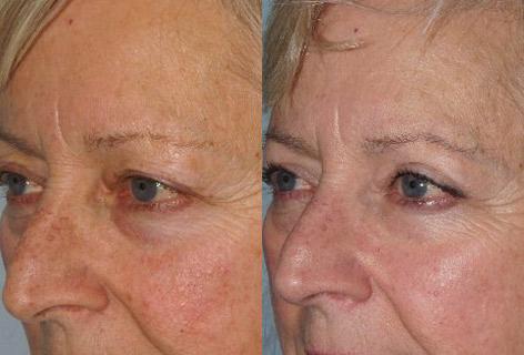 Blepharoplasty before and after photos in San Francisco, CA, Patient 13068