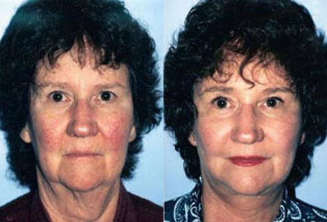 Browlift before and after photos in San Francisco, CA, Patient 13073