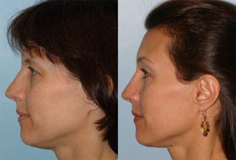 Browlift before and after photos in San Francisco, CA, Patient 13078