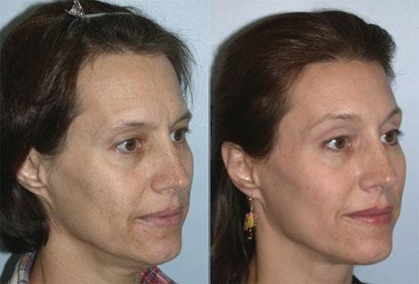 Browlift before and after photos in San Francisco, CA, Patient 13078