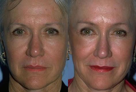 Browlift before and after photos in San Francisco, CA, Patient 13088