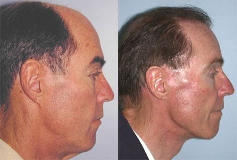 Browlift before and after photos in San Francisco, CA, Patient 13091