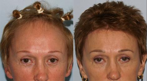 Browlift before and after photos in San Francisco, CA, Patient 13099