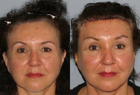 Browlift before and after photos in San Francisco, CA, Patient 13104