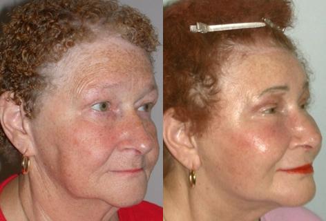 Browlift before and after photos in San Francisco, CA, Patient 13111