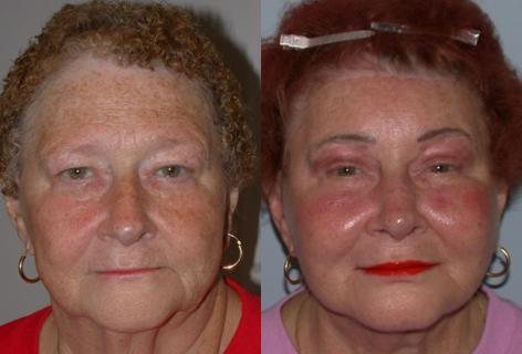 Browlift before and after photos in San Francisco, CA, Patient 13111