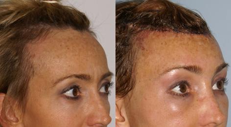 Browlift before and after photos in San Francisco, CA, Patient 13116