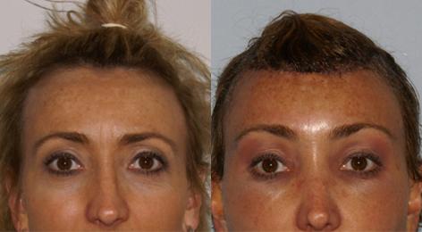 Browlift before and after photos in San Francisco, CA, Patient 13116