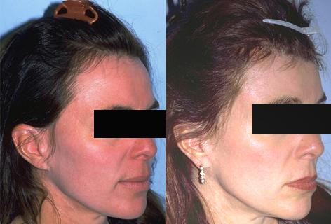 Browlift before and after photos in San Francisco, CA, Patient 13125