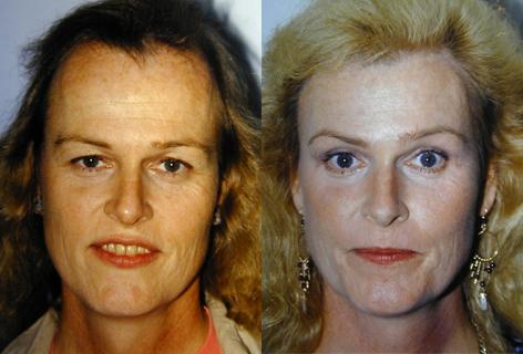 Browlift before and after photos in San Francisco, CA, Patient 13128