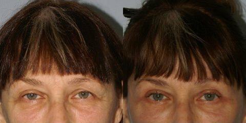 Browlift before and after photos in San Francisco, CA, Patient 13132