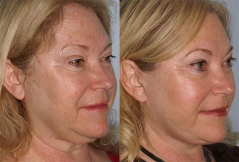 Cheek Implant before and after photos in San Francisco, CA, Patient 13135