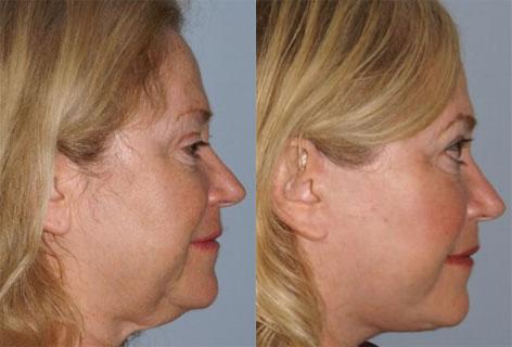 Cheek Implant before and after photos in San Francisco, CA, Patient 13135
