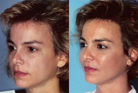 Cheek Implant before and after photos in San Francisco, CA, Patient 13142