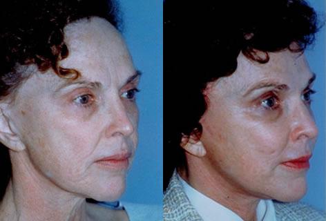 Cheek Implant before and after photos in San Francisco, CA, Patient 13147