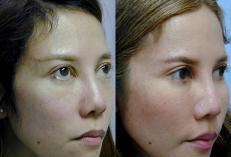 Cheek Implant before and after photos in San Francisco, CA, Patient 13152