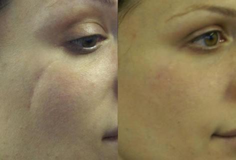 Cheek Implant before and after photos in San Francisco, CA, Patient 13155