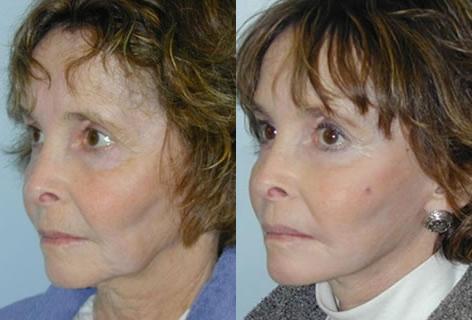 Cheek Implant before and after photos in San Francisco, CA, Patient 13158