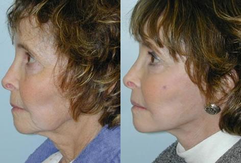 Cheek Implant before and after photos in San Francisco, CA, Patient 13158