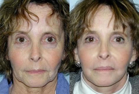 Cheek Implant before and after photos in San Francisco, CA, Patient 13158