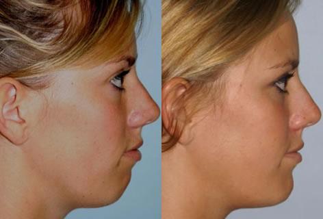 Chin Implant before and after photos in San Francisco, CA, Patient 13170