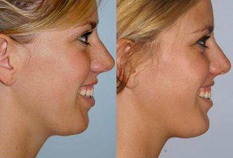 Chin Implant before and after photos in San Francisco, CA, Patient 13170
