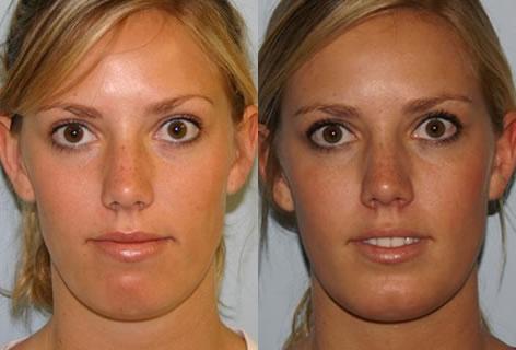 Chin Implant before and after photos in San Francisco, CA, Patient 13170