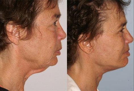 Chin Implant before and after photos in San Francisco, CA, Patient 13177