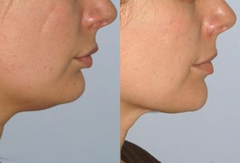 Chin Implant before and after photos in San Francisco, CA, Patient 13180