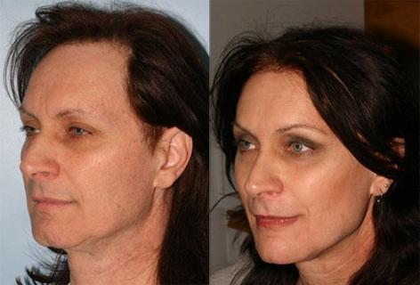 Chin Implant before and after photos in San Francisco, CA, Patient 13183