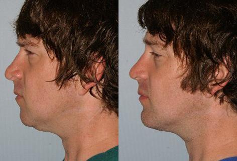 Chin Implant before and after photos in San Francisco, CA, Patient 13184