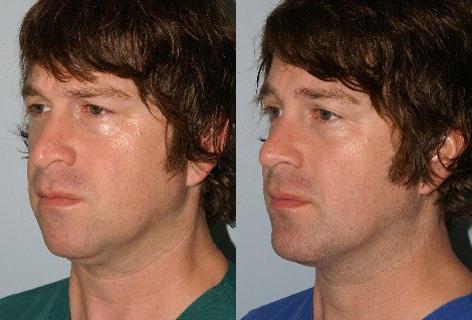 Chin Implant before and after photos in San Francisco, CA, Patient 13184