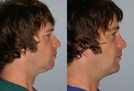 Chin Implant before and after photos in San Francisco, CA, Patient 13184