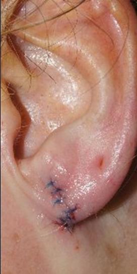 Earlobe Repair before and after photos in San Francisco, CA, Patient 13216