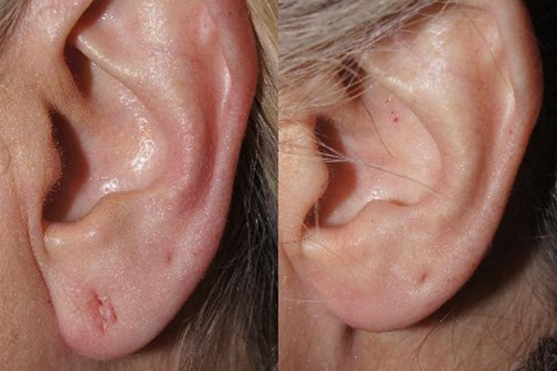 Earlobe Repair before and after photos in San Francisco, CA, Patient 13216