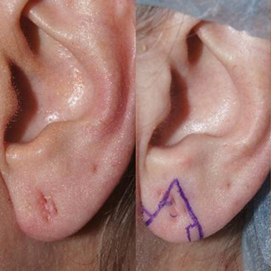 Earlobe Repair before and after photos in San Francisco, CA, Patient 13216