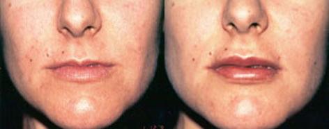 Lips before and after photos in San Francisco, CA, Lip Augmentation in San Francisco, CA