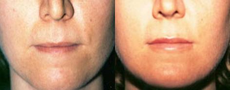 Lips before and after photos in San Francisco, CA, Patient 13259