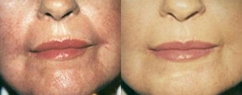 Lips before and after photos in San Francisco, CA, Patient 13262
